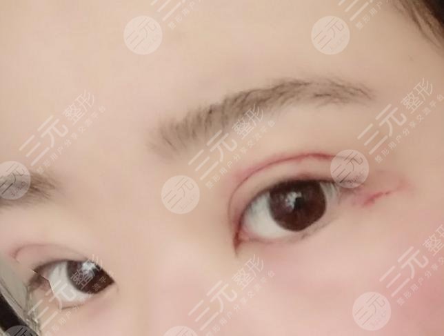 蘭大二院整形科專(zhuān)家雙眼皮案例
