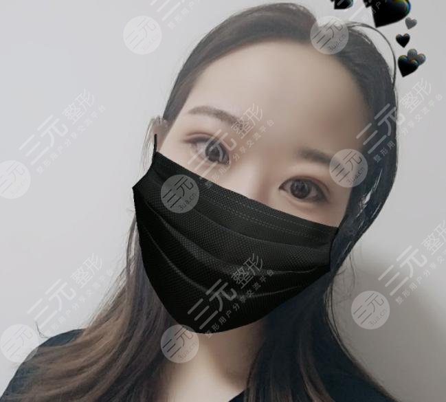 蘭大二院整形科專(zhuān)家雙眼皮案例