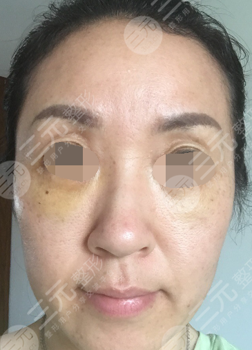 面部年輕化plus全臉，快速解決面部問(wèn)題，內(nèi)附真實(shí)案例分享圖