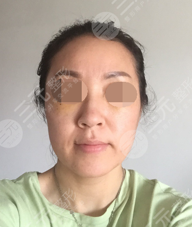 面部年輕化plus全臉，快速解決面部問(wèn)題，內(nèi)附真實(shí)案例分享圖