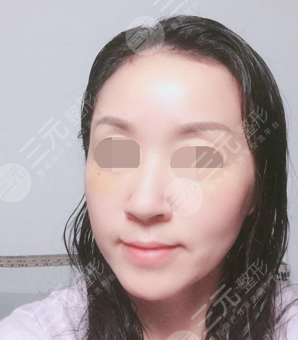 面部年輕化plus全臉，快速解決面部問(wèn)題，內(nèi)附真實(shí)案例分享圖
