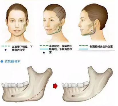 下頜骨手術(shù)有哪幾種方式