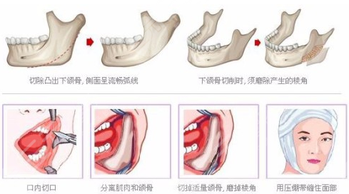 下頜骨手術(shù)的操作方法