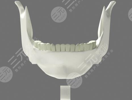 下頜骨手術(shù)價(jià)格大概需要多少錢？下頜骨手術(shù)的護(hù)理注意事項(xiàng)