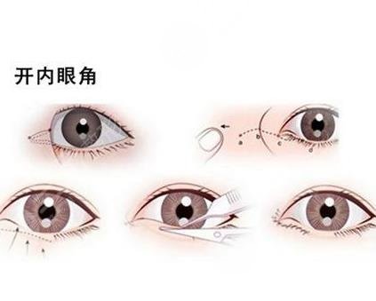 不適合開眼角眼型