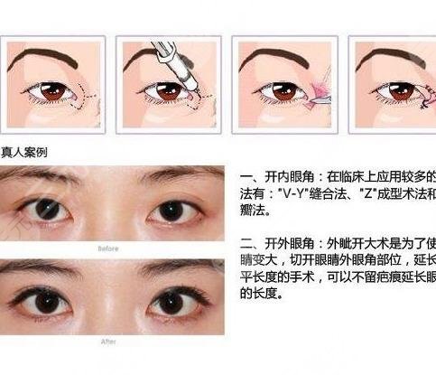 開眼角手術(shù)適合哪些人？
