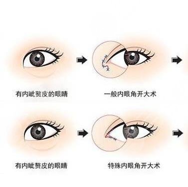 開眼角手術(shù)后的注意事項(xiàng)