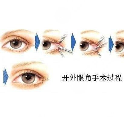開眼角手術(shù)后