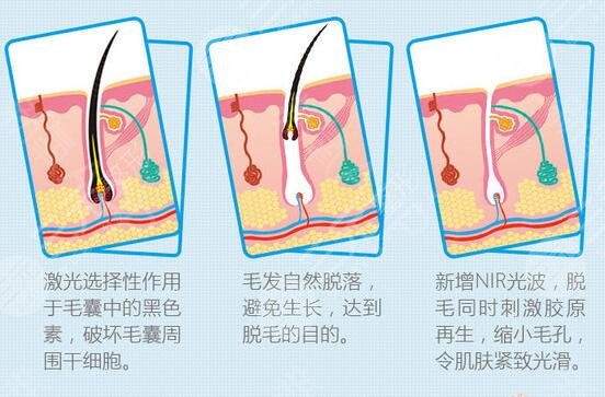 激光脫毛