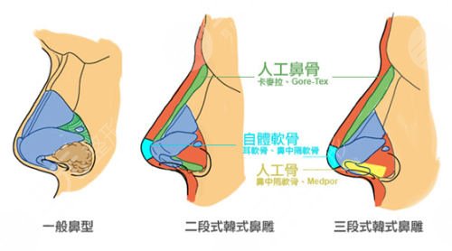 鼻翼縮小修復