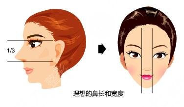 鼻翼縮小修復