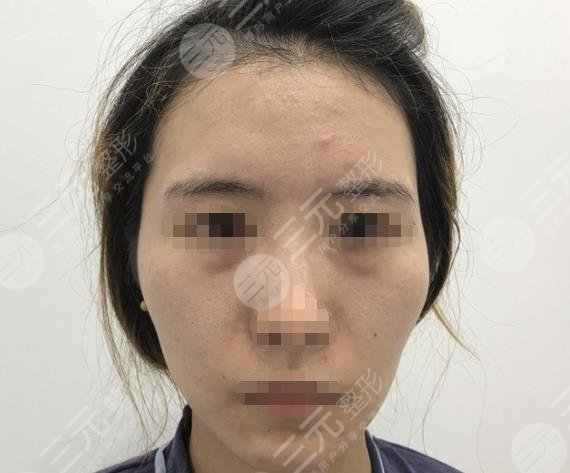西安西京醫(yī)院整形美容科面部脂肪填充過程