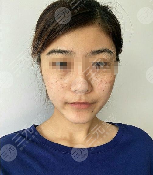 黑臉娃娃嫩膚后半個(gè)月