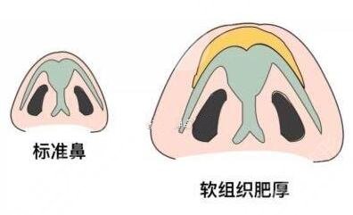 肥厚鼻尖矯正術(shù)方法原理