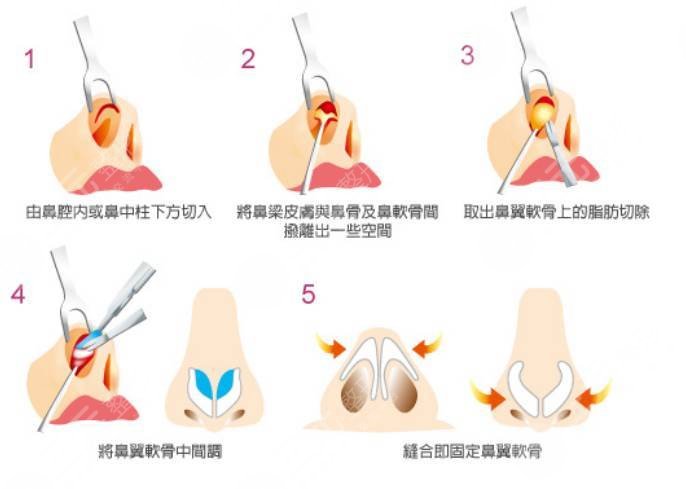 肥厚鼻尖矯正術(shù)方法原理