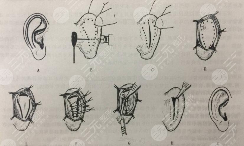 顱耳角在30°-60°之間是一種天生畸形，矯正方法如下