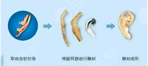 郭樹忠再造耳費(fèi)用