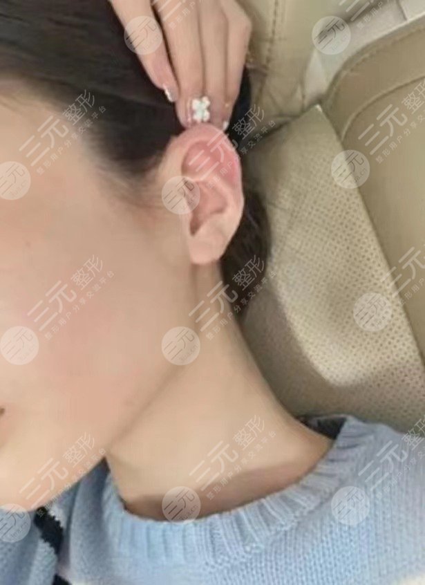 貼發(fā)耳矯正手術(shù)大概多少錢