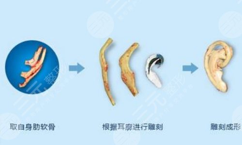 耳再造手術(shù)的優(yōu)勢(shì)