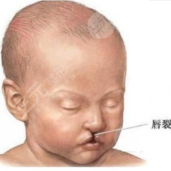 唇腭裂修復手術大概需要多少費用？什么原因導致了唇腭裂的產(chǎn)生？