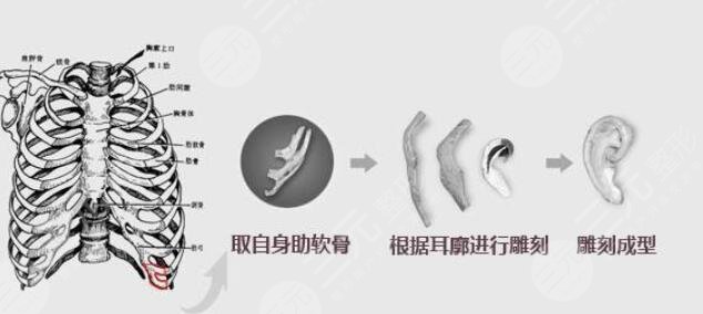 耳再造全包手術的原理