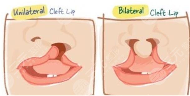 唇腭裂修復手術的費用是多少呢