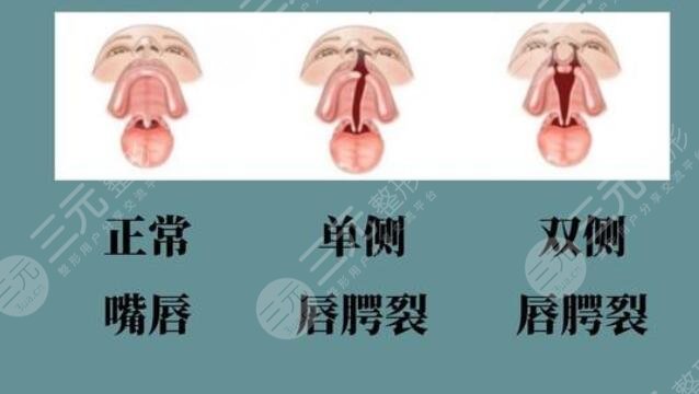 唇裂術后應該注意什么
