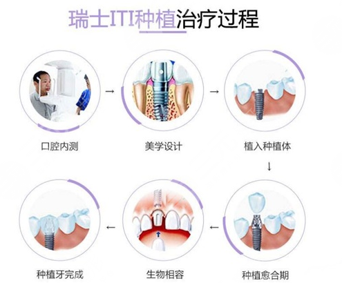 瑞士種植體iti三種檔次