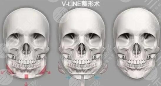 V-LINE瓜子臉手術(shù)保持多久