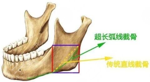 磨骨消腫恢復(fù)期為3個(gè)月左右