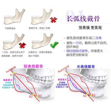 磨骨改臉型手術(shù)過(guò)程
