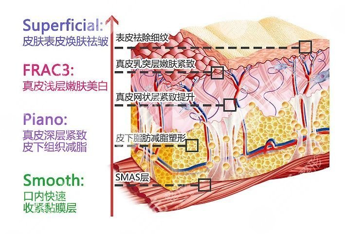 整形美容醫(yī)院Fotona4D科普
