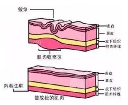 注射除皺的作用有哪些