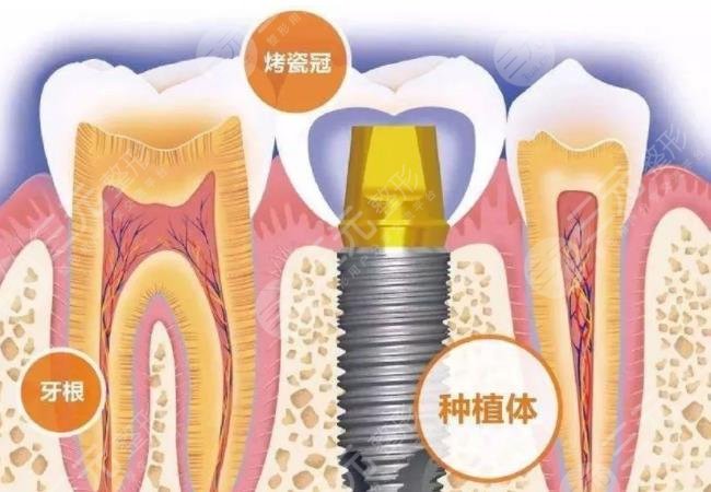 種植牙手術后的注意事項