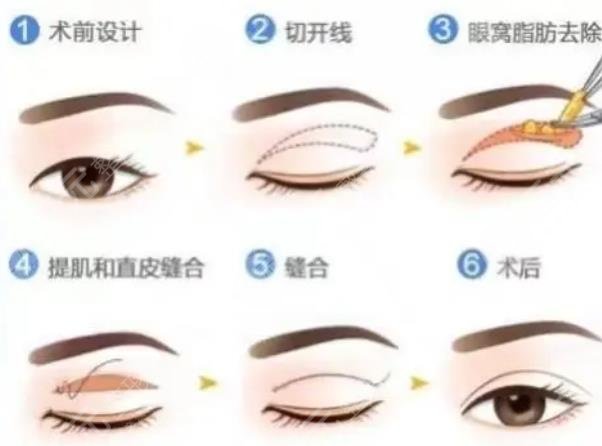 雙眼皮整形手術(shù)原理