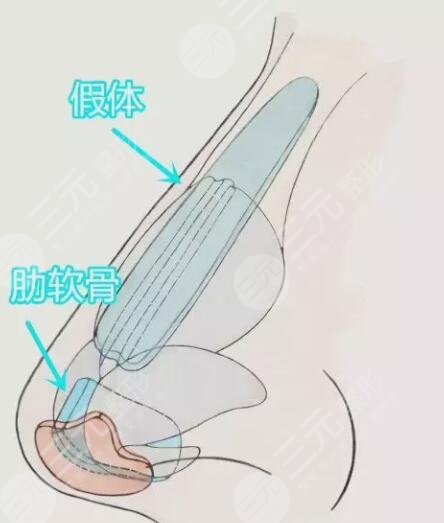 自體軟骨隆鼻降低風(fēng)險(xiǎn)嗎？自體軟骨隆鼻的優(yōu)勢(shì)及注意事項(xiàng)，姐妹們學(xué)起來！