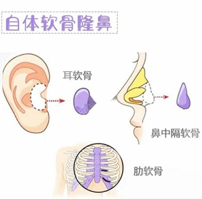 自體軟骨隆鼻降低風(fēng)險(xiǎn)嗎