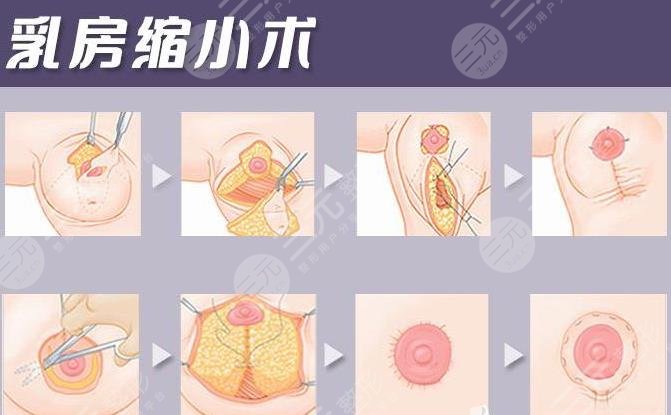 棒棒糖縮胸手術后圖片