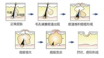 彩光祛痘果怎么樣?