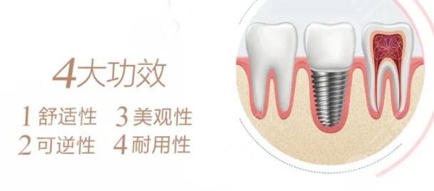 全口種植牙術(shù)后可以維持多久