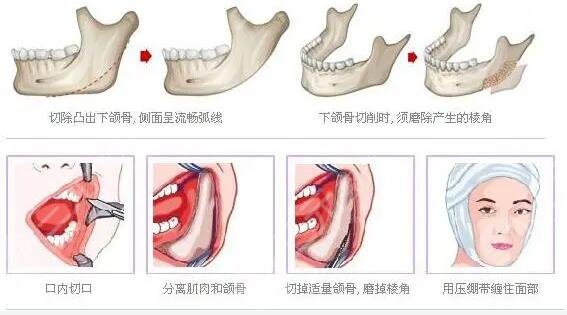 顴骨整形術(shù)的恢復(fù)時(shí)間