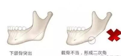 磨骨手術(shù)術(shù)后要怎么做