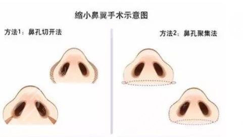 鼻翼縮小