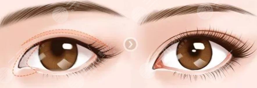 開眼角