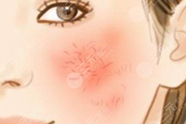 紅血絲