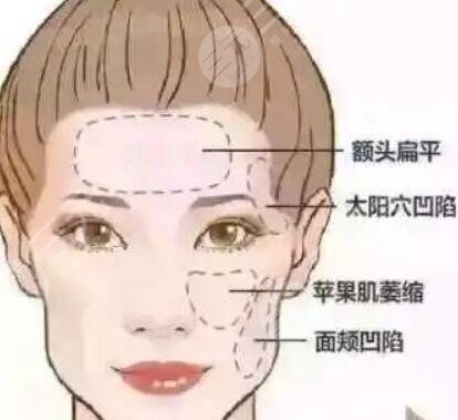 北京偉力嘉美信整形果如何？埋埋提升前后驚人對比