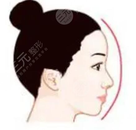 廈門(mén)華美謝常禮隆鼻案例