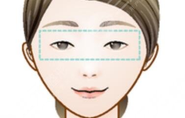 趙成利雙眼皮修復(fù)案例：術(shù)前形狀假寬，修復(fù)后雙眼自然、溫柔，好愛！