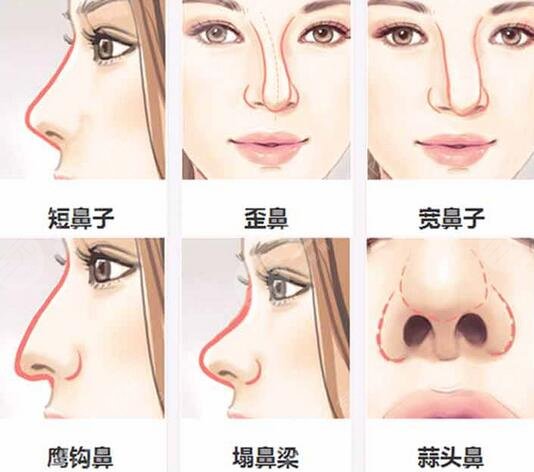 王晉煌做假體隆鼻前