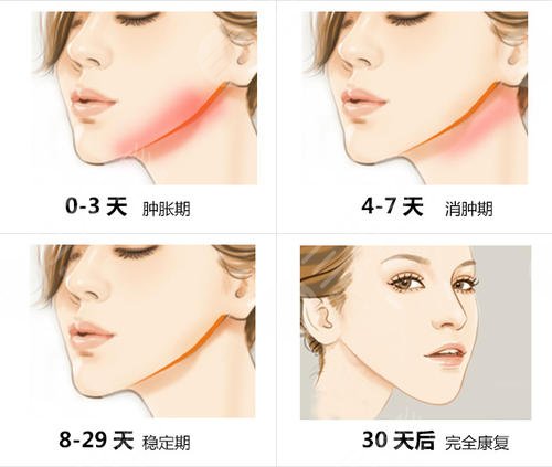 顴骨整形術(shù)的原理是什么
